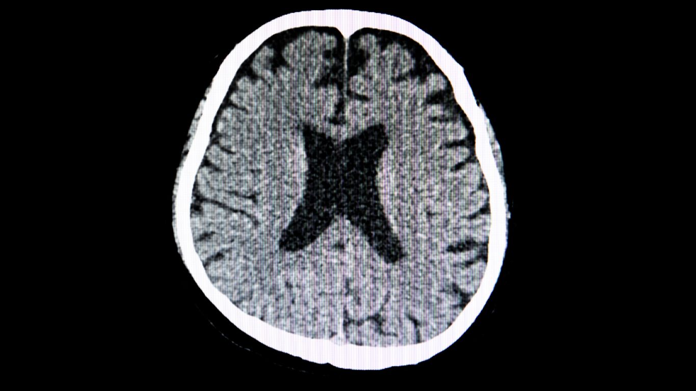 Tomografía de Cráneo – Diagnóstico Preciso en Puebla